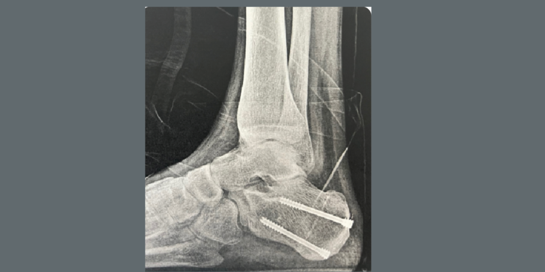 Charcot-Marie-Tooth Disease: Surgical Management of a Progressive Disease State